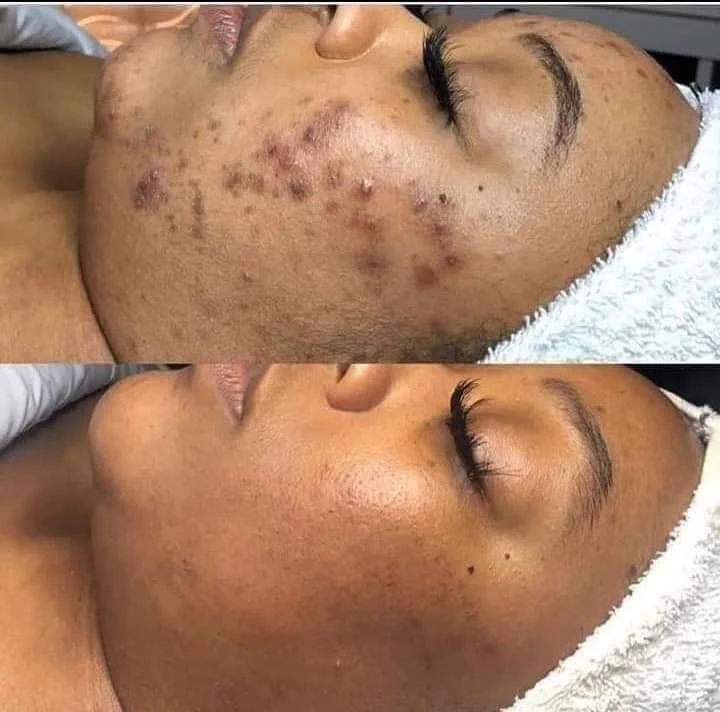 Sérum the ordinary(Niacinamide) BKF